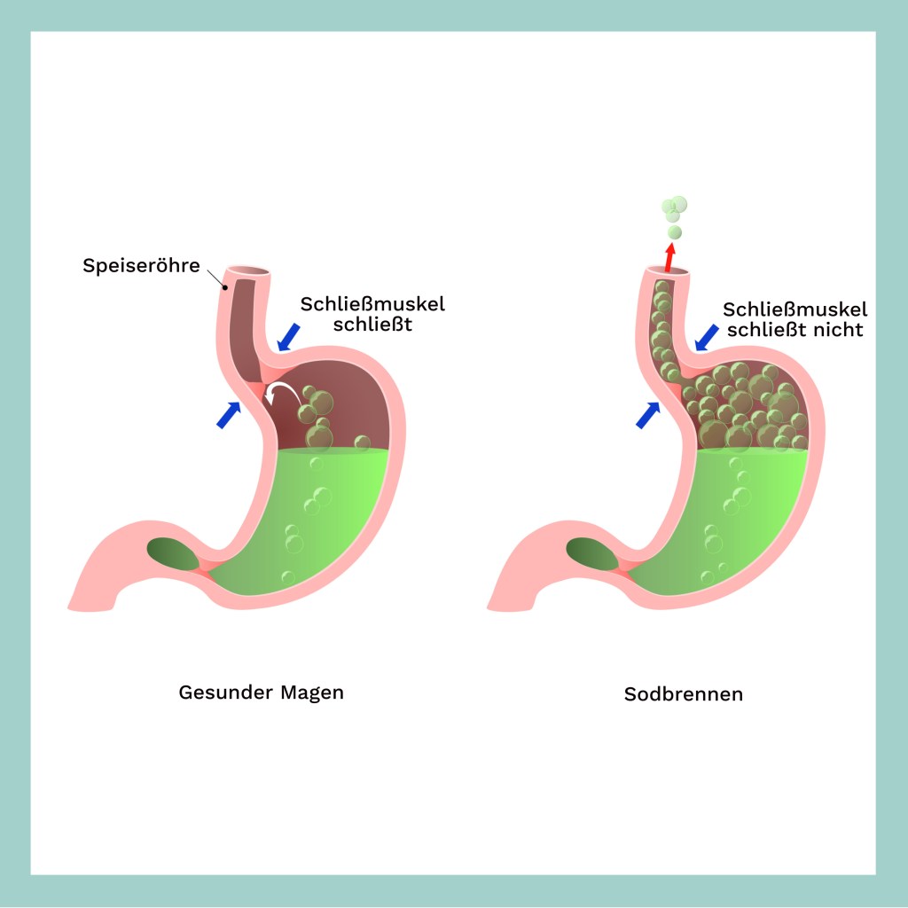 Vergleichende Grafik von gesundem Magen und Sodbrennen mit Beschriftungen.