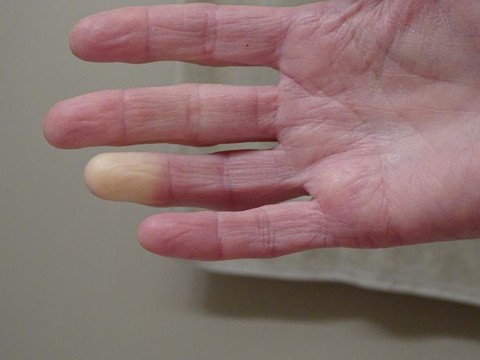 Durchblutungsstörung: Das Raynaud-Syndrom