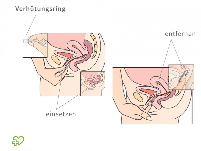 So sitzt der Verhütungsring richtig