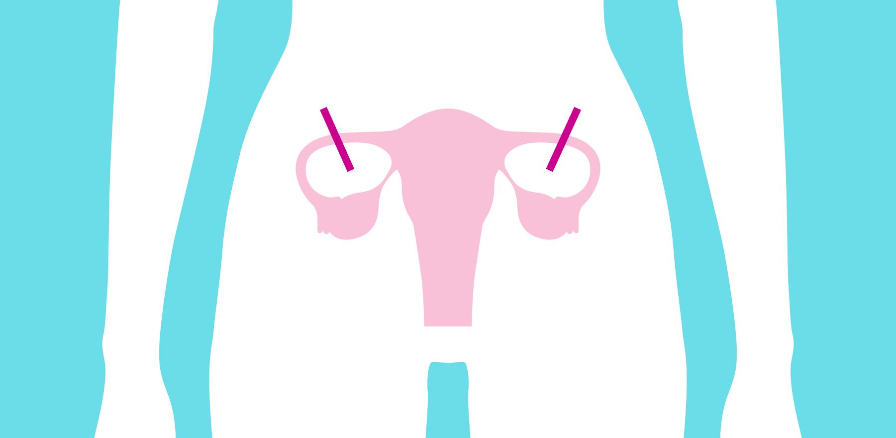 Sterilisation der Frau: So funktioniert es