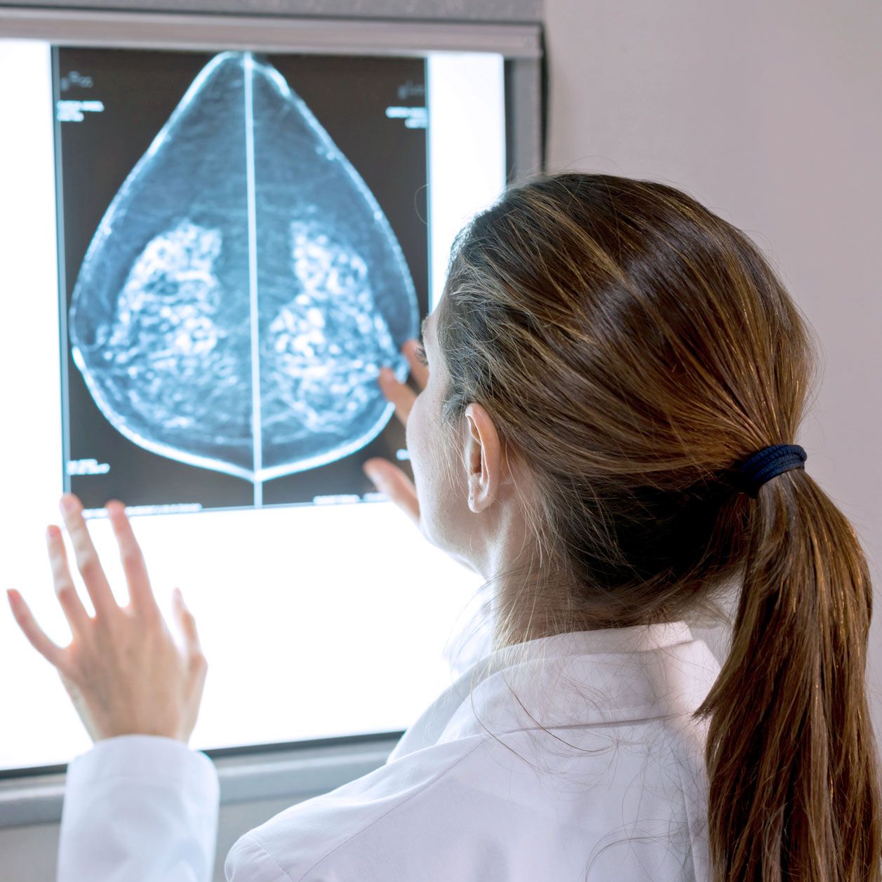 Die Mammographie ist ein Hilfsmittel zur Frühdiagnostik von Brustkrebs.