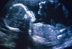 Ultraschall in der Schwangerschaft