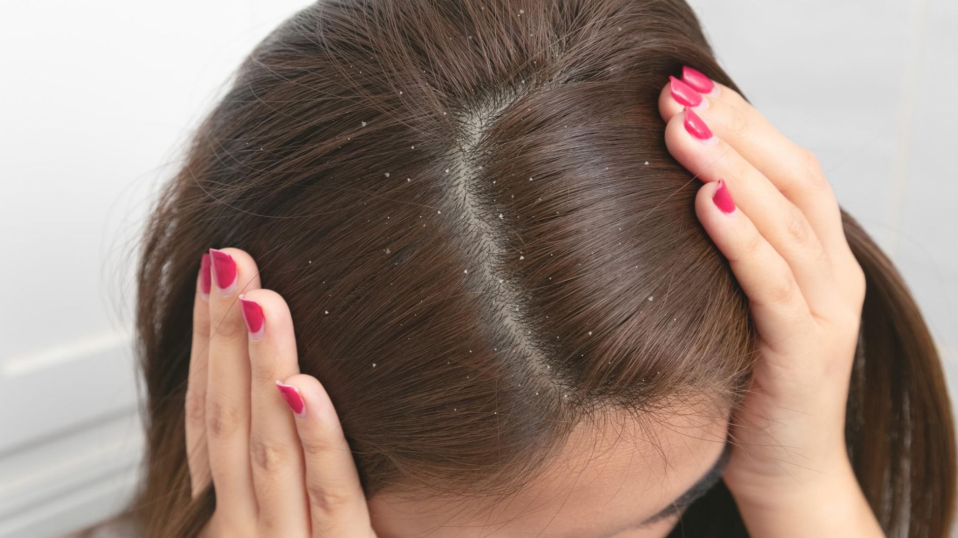 Haare mit Schuppen Haare mit Schuppen