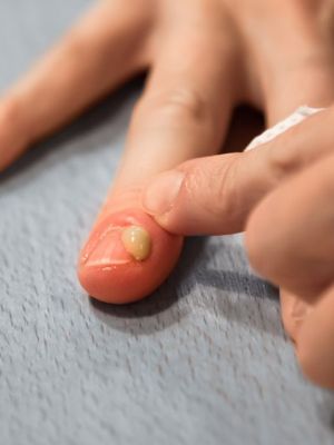 Nagelbettentzündung: Diese Hausmittel helfen dir wirklich