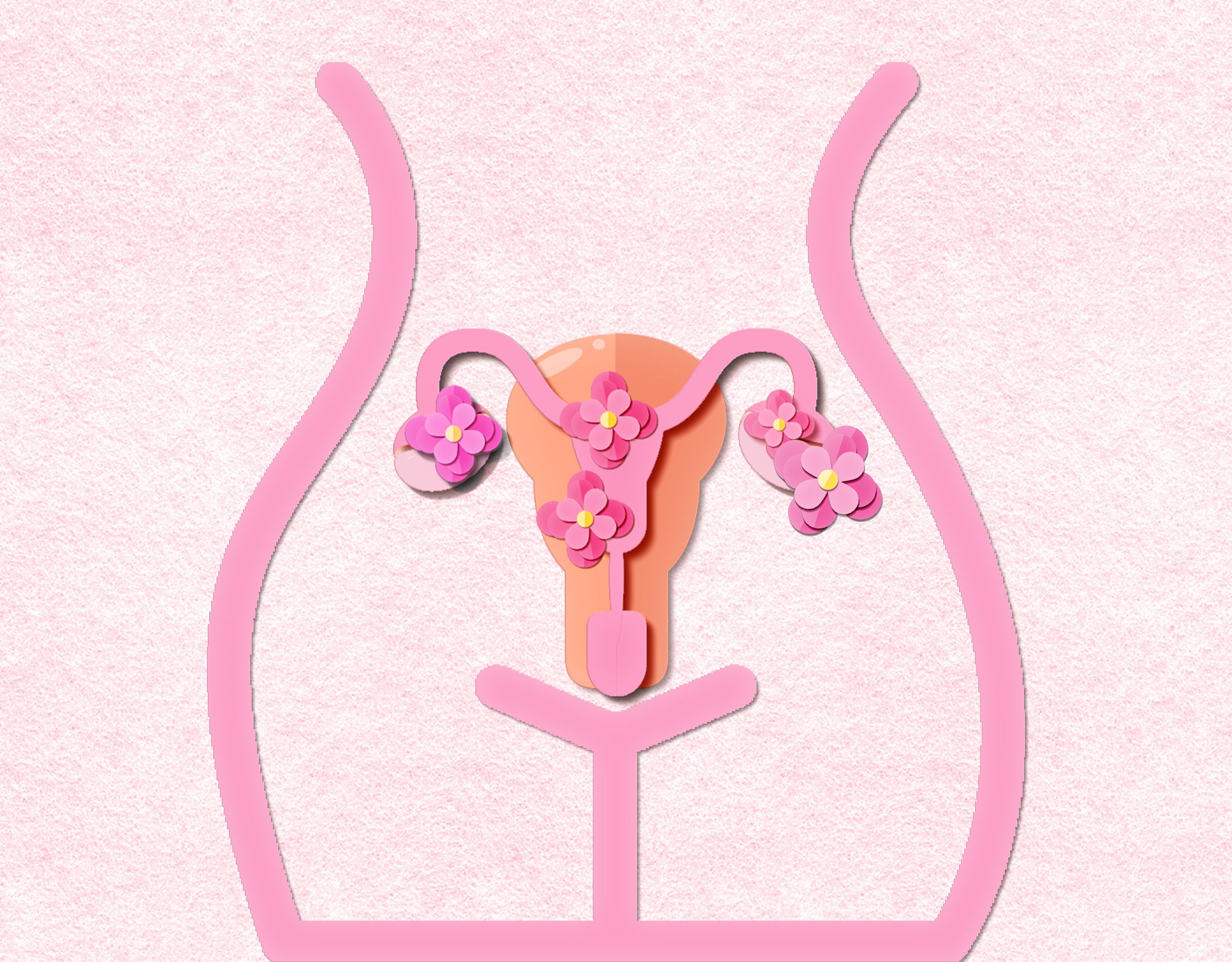 Unterleib mit Zysten und Endometriose