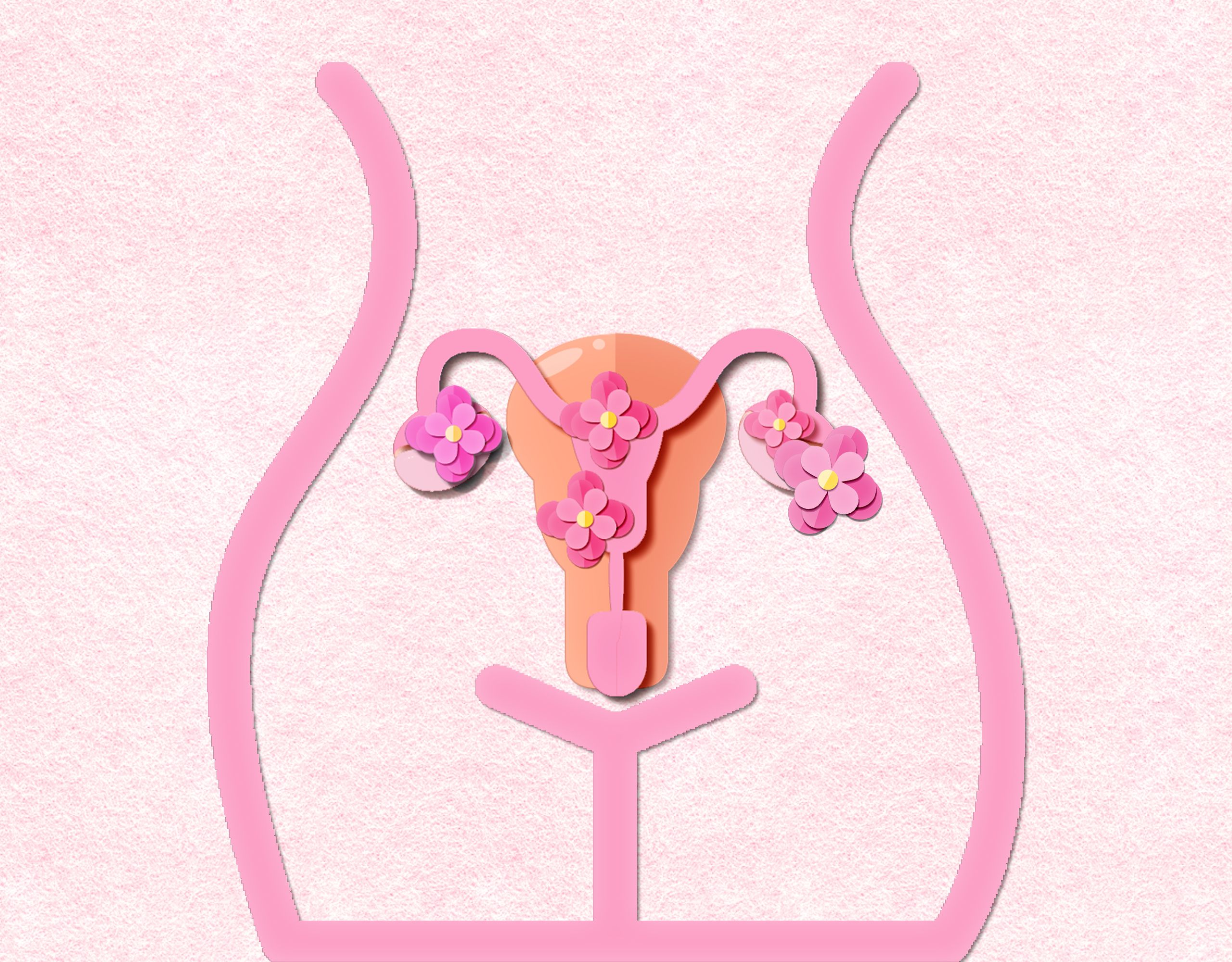 Unterleib mit Zysten und Endometriose Unterleib mit Zysten und Endometriose