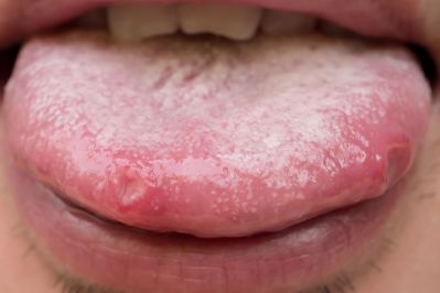 Weiße Pickel auf der Zunge: Bild einer Zunge mit Aphten