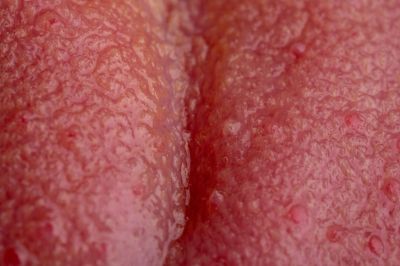 Rote Pickel auf der Zunge: Bild von Papillen
