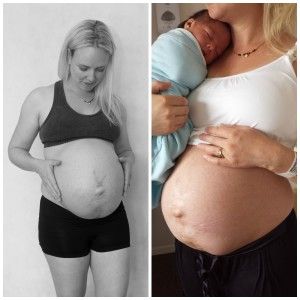 32. SSW vs. 24 Stunden nach der Geburt