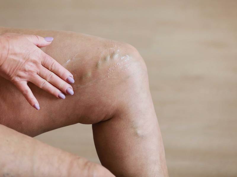 Die Frau reibt ihre müden Beine mit einer speziellen Creme ein, um die Schmerzen zu lindern.