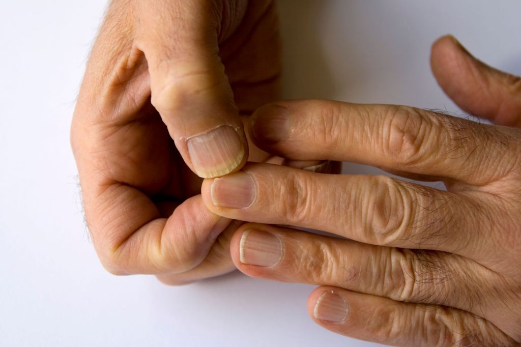 Bild älterer Hände mit tiefen Längsrillen in den Fingernägeln