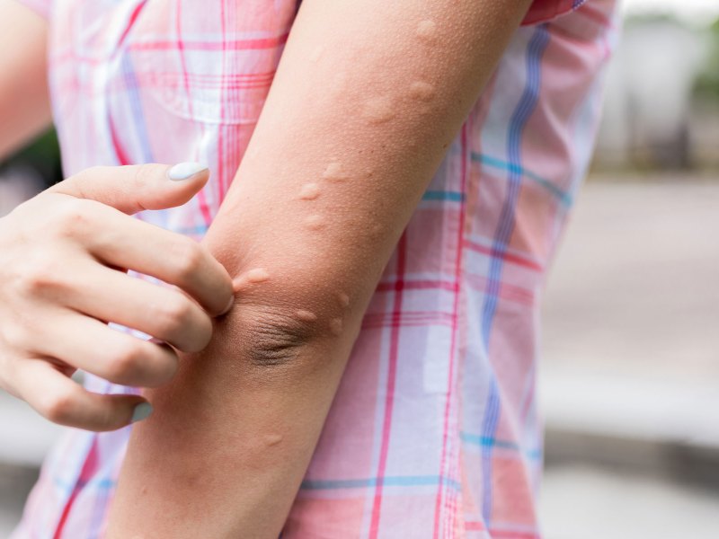 Arm mit vielen Mückenstichen